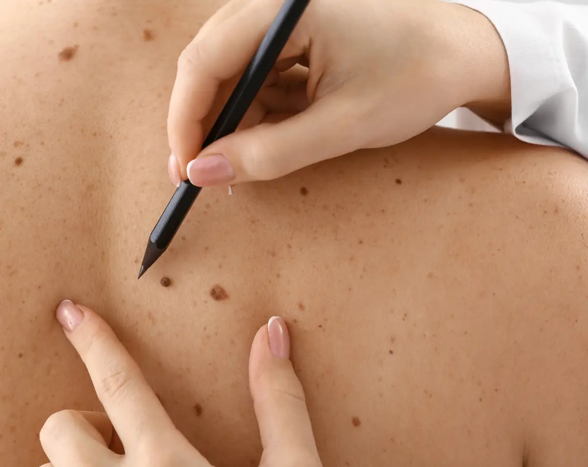 Skin Cancer Prevention Image 02