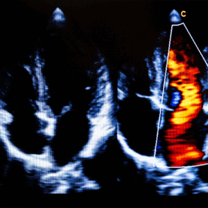 Echocardiogram