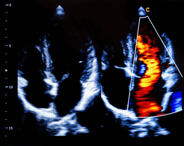 Echocardiogram