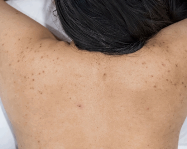 Micro-Needling Back