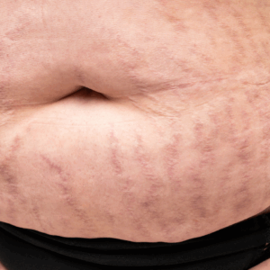 Micro-Needling Belly