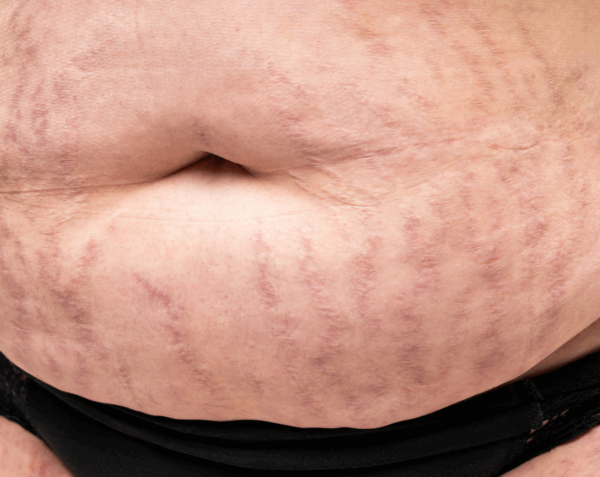 Micro-Needling Belly