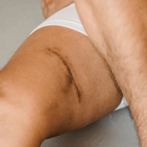 Micro-Needling Thighs