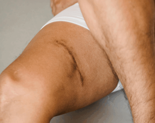 Micro-Needling Thighs