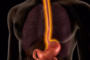 Esophageal Cancer Is on the Rise Here’s What You Can Do About It
