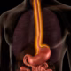 Esophageal cancer illustration and rising incidence, medical information from Desert Mobile Medical
