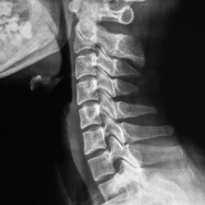 Cervical Spine X-Ray
