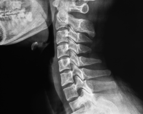 Cervical Spine X-Ray
