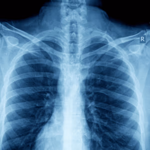 Chest X-Ray