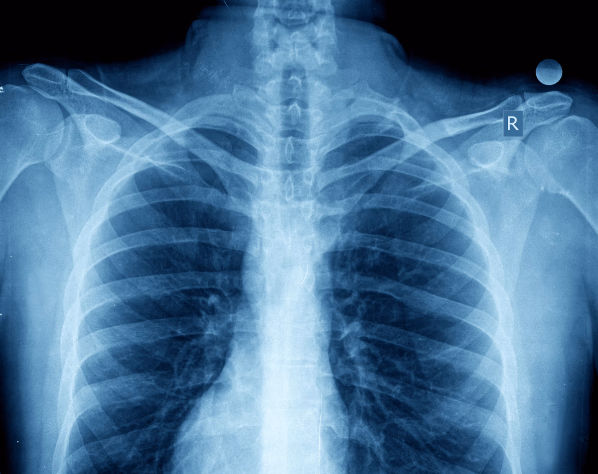 Chest X-Ray