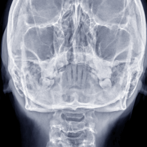 Facial Bones X-Ray