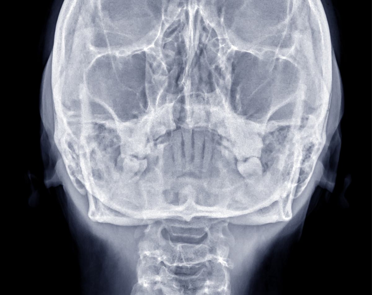 Facial Bones X-Ray