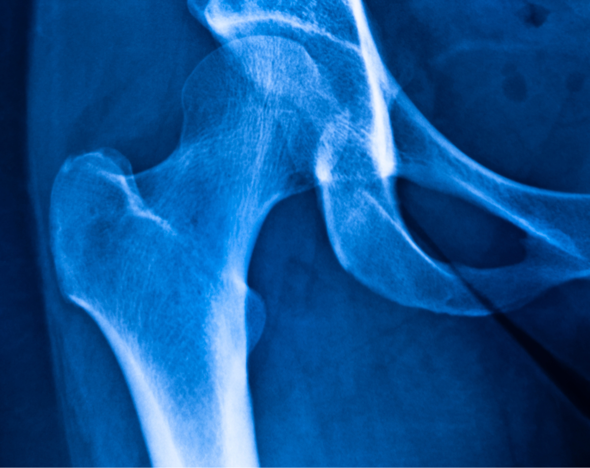 Femur (Thigh Bone) X-Ray