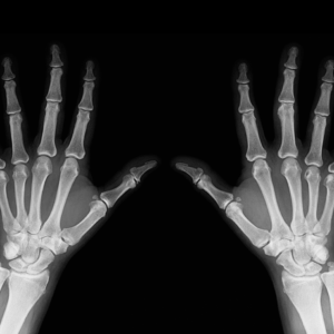 Fingers X-Ray