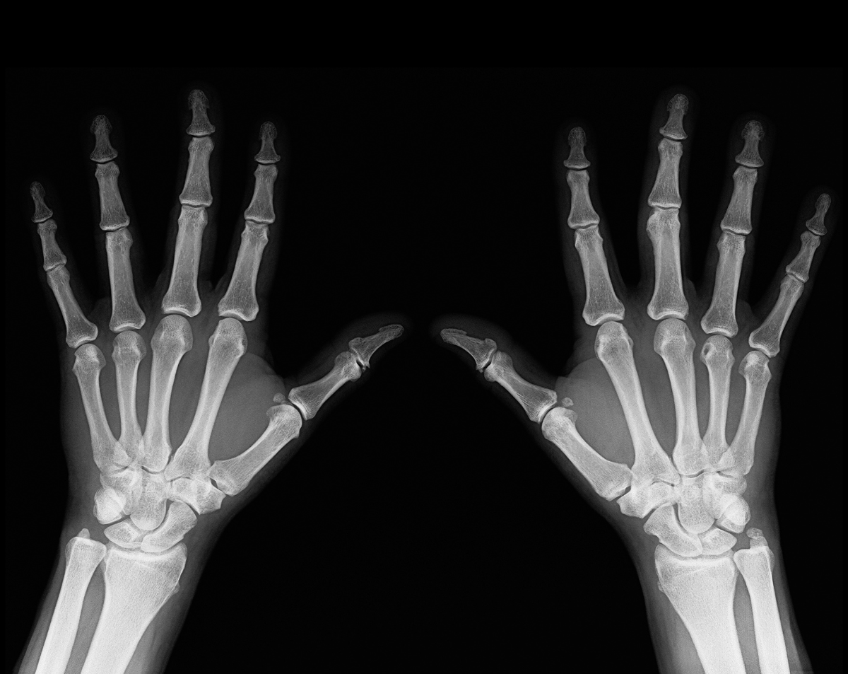 Fingers X-Ray