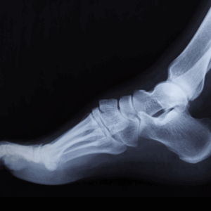 Foot X-Ray