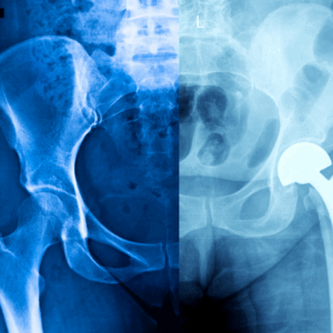 Hip X-Ray