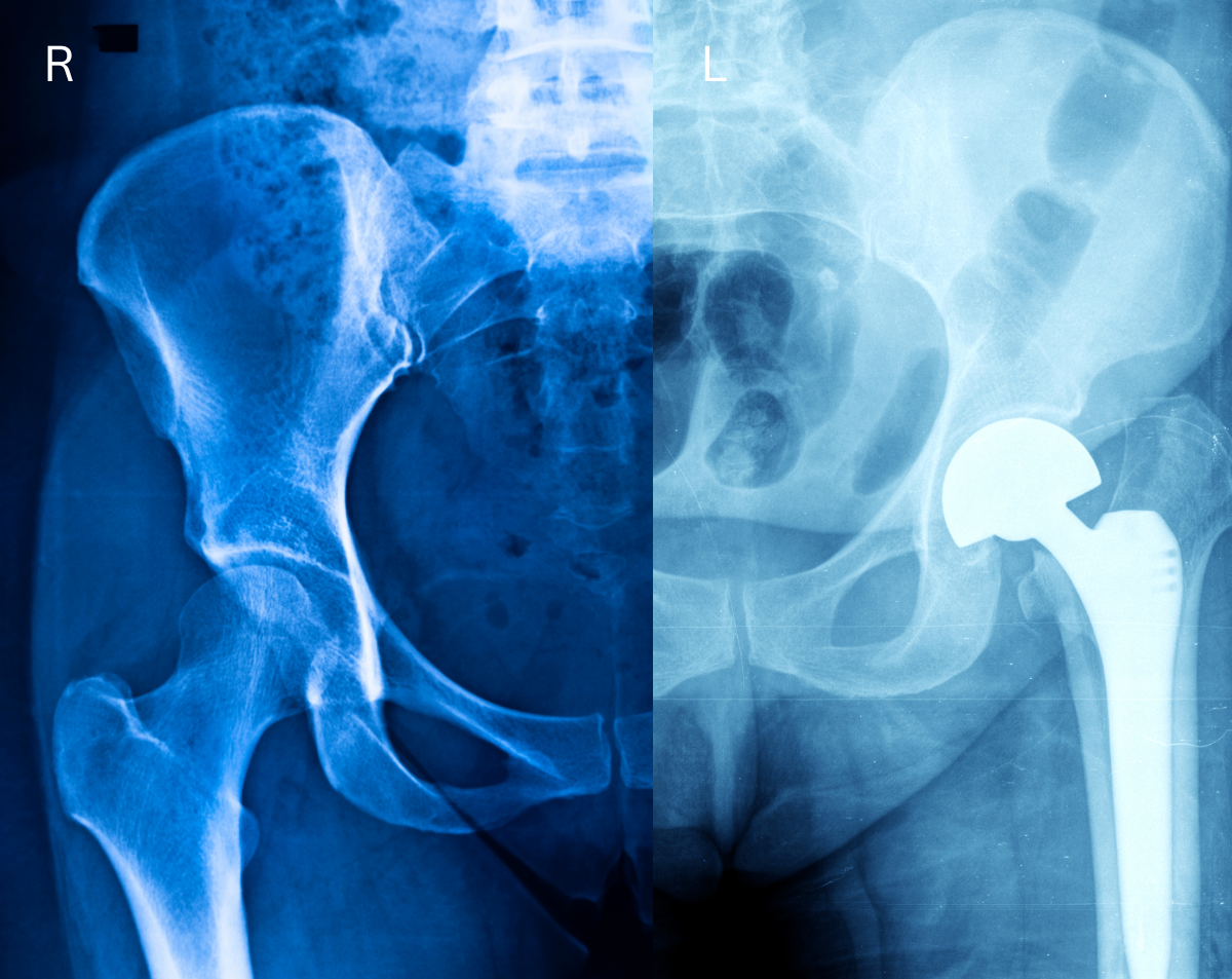 Hip X-Ray