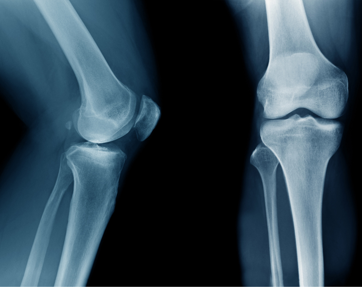 Knee X-Ray