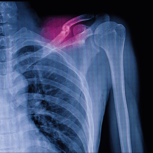 Left Clavicle X-Ray