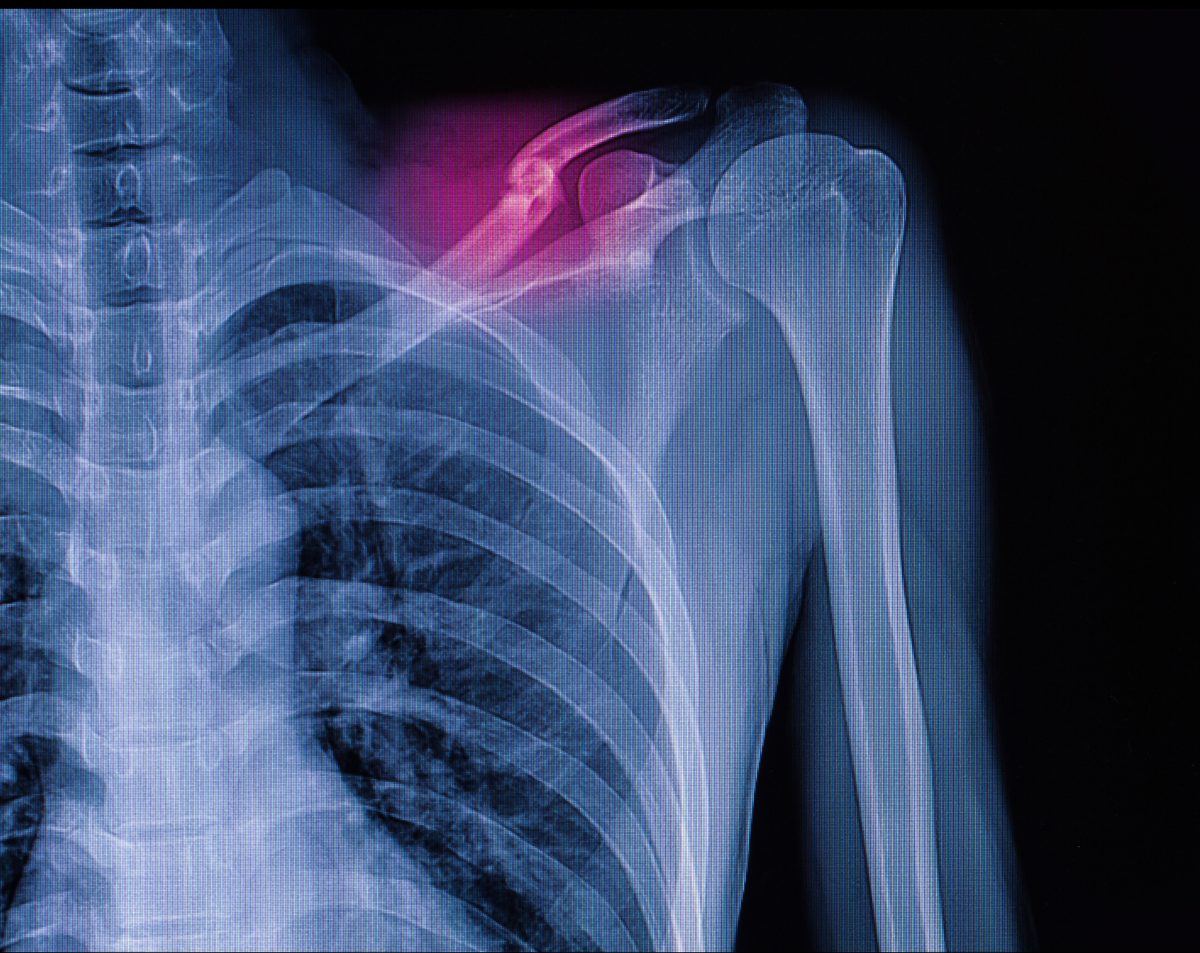 Left Clavicle X-Ray