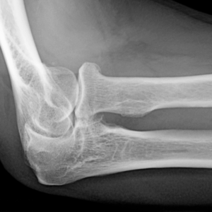Left Elbow X-Ray