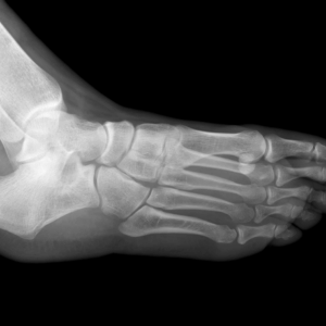Left Foot X-Ray