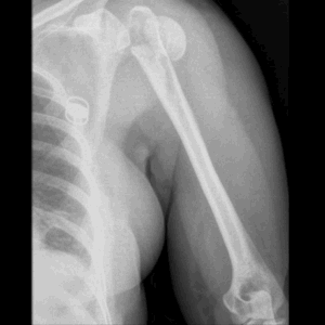 Left Humerus (Upper Arm) X-Ray