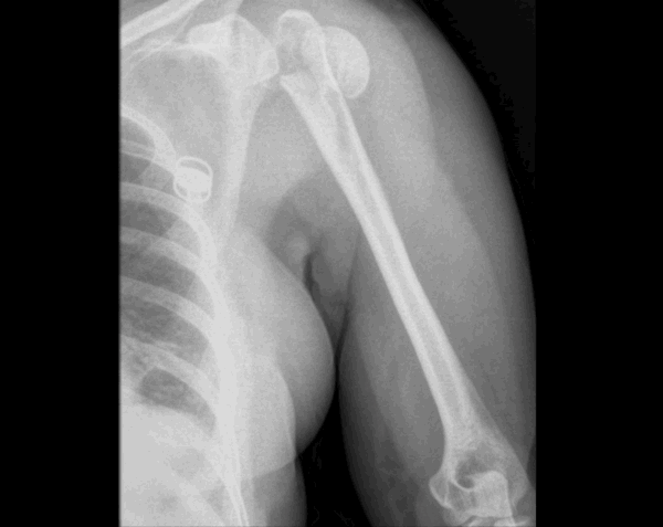 Left Humerus (Upper Arm) X-Ray