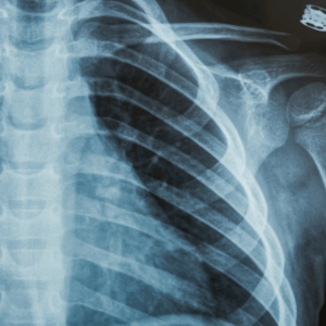 Left Rib Series X-Ray