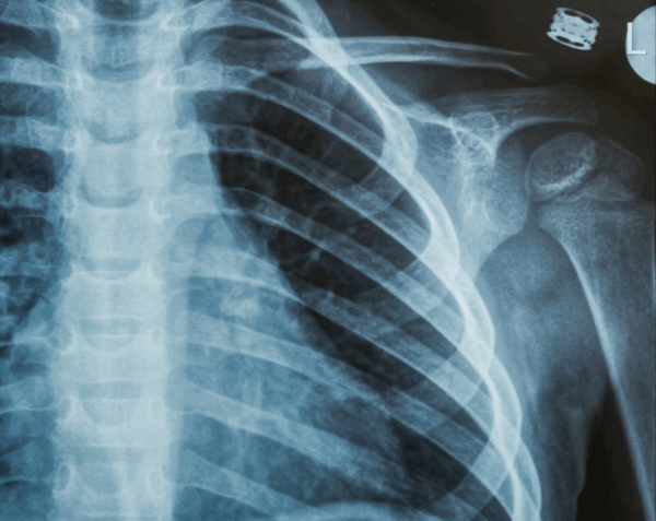 Left Rib Series X-Ray