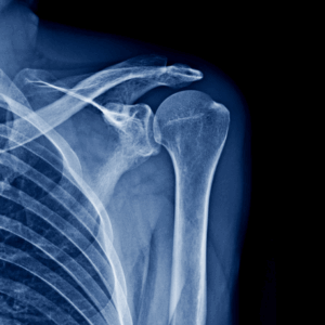 Left Shoulder X-Ray