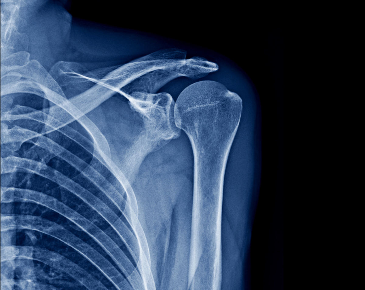 Left Shoulder X-Ray