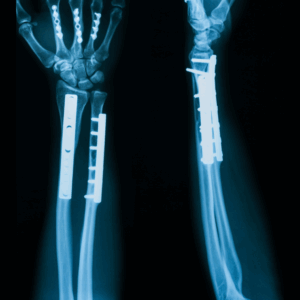 Left Forearm X-Ray