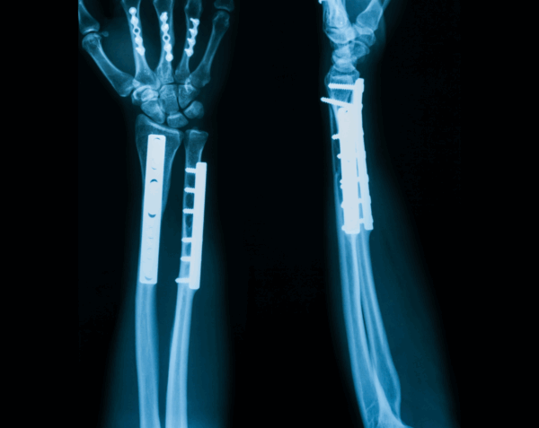 Left Forearm X-Ray