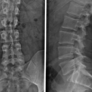 Lumbar Spine X-Ray
