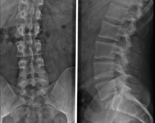 Lumbar Spine X-Ray