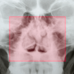 Nasal Bones X-Ray