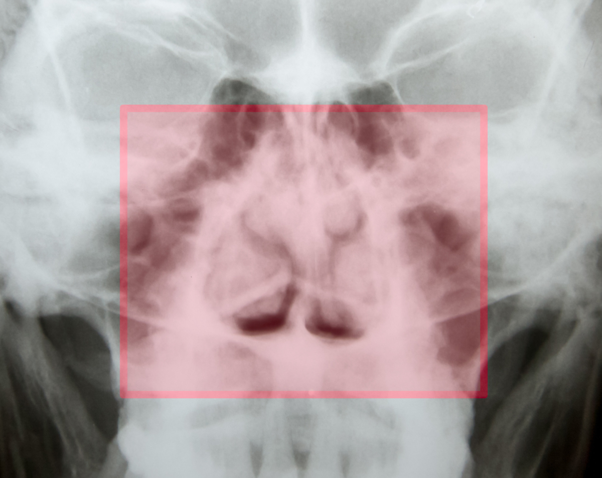 Nasal Bones X-Ray