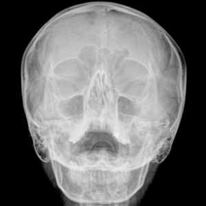 Paranasal Sinuses X-Ray