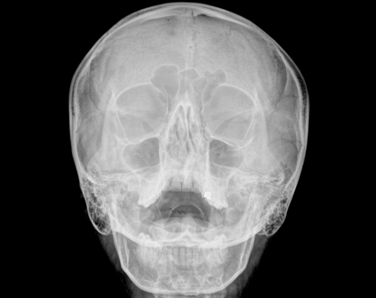 Paranasal Sinuses X-Ray