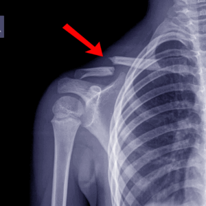Right Clavicle X-Ray