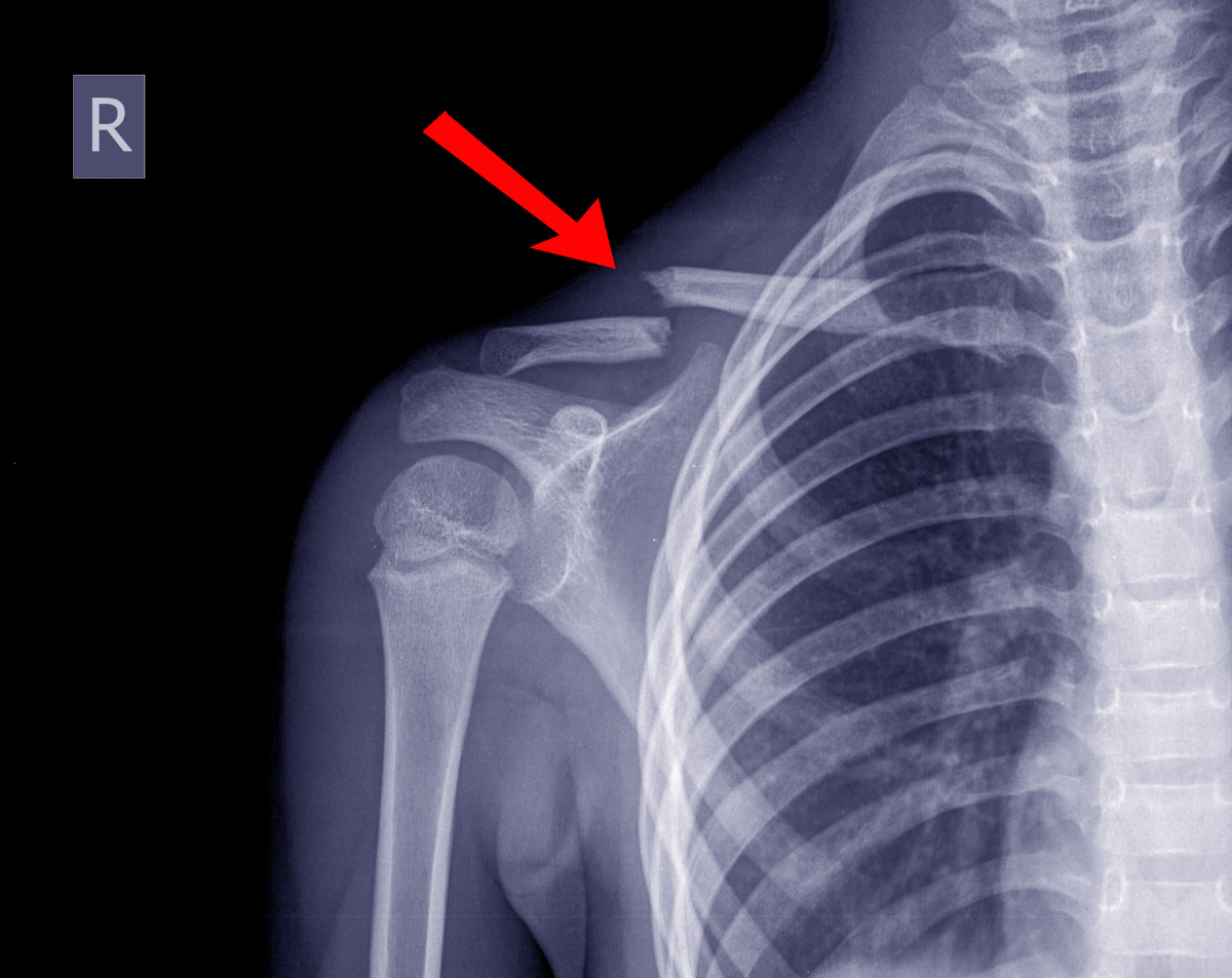 Right Clavicle X-Ray