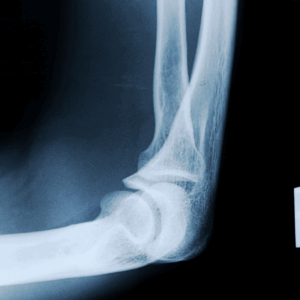 Right Elbow X-Ray