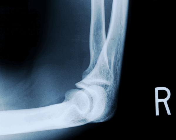 Right Elbow X-Ray