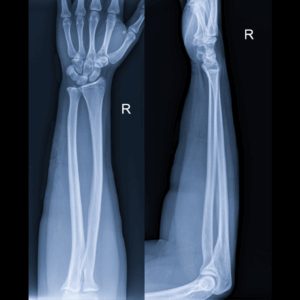Right Forearm X-Ray