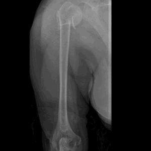 Right Humerus (Upper Arm) X-Ray