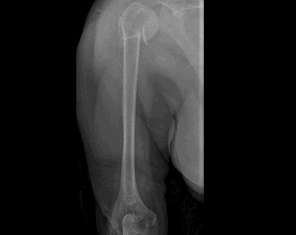 Right Humerus (Upper Arm) X-Ray