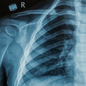Right Rib Series X-Ray