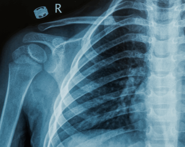 Right Rib Series X-Ray